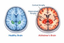 Medical brain scans comparing healthy brain tissue against alzheimer's-disease related atrophy in the hippocampus and cortex regions.