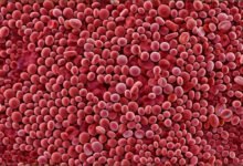 Vitamin deficiency anemia megaloblastic cells versus healthy red blood cells comparison.